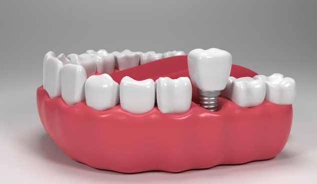 Top 7 Dental Implants Complications To Watch Out For in Midwest City