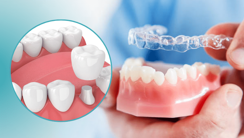 Invisalign with a crown- Midwest City