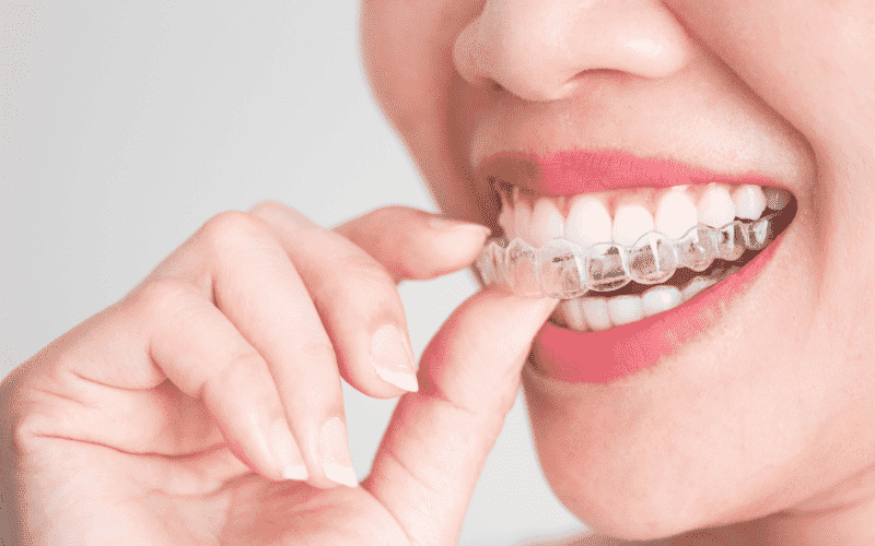 Can Invisalign Fix My Crowded Teeth