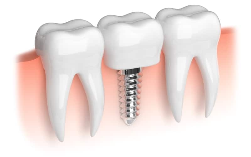 dental implant complications