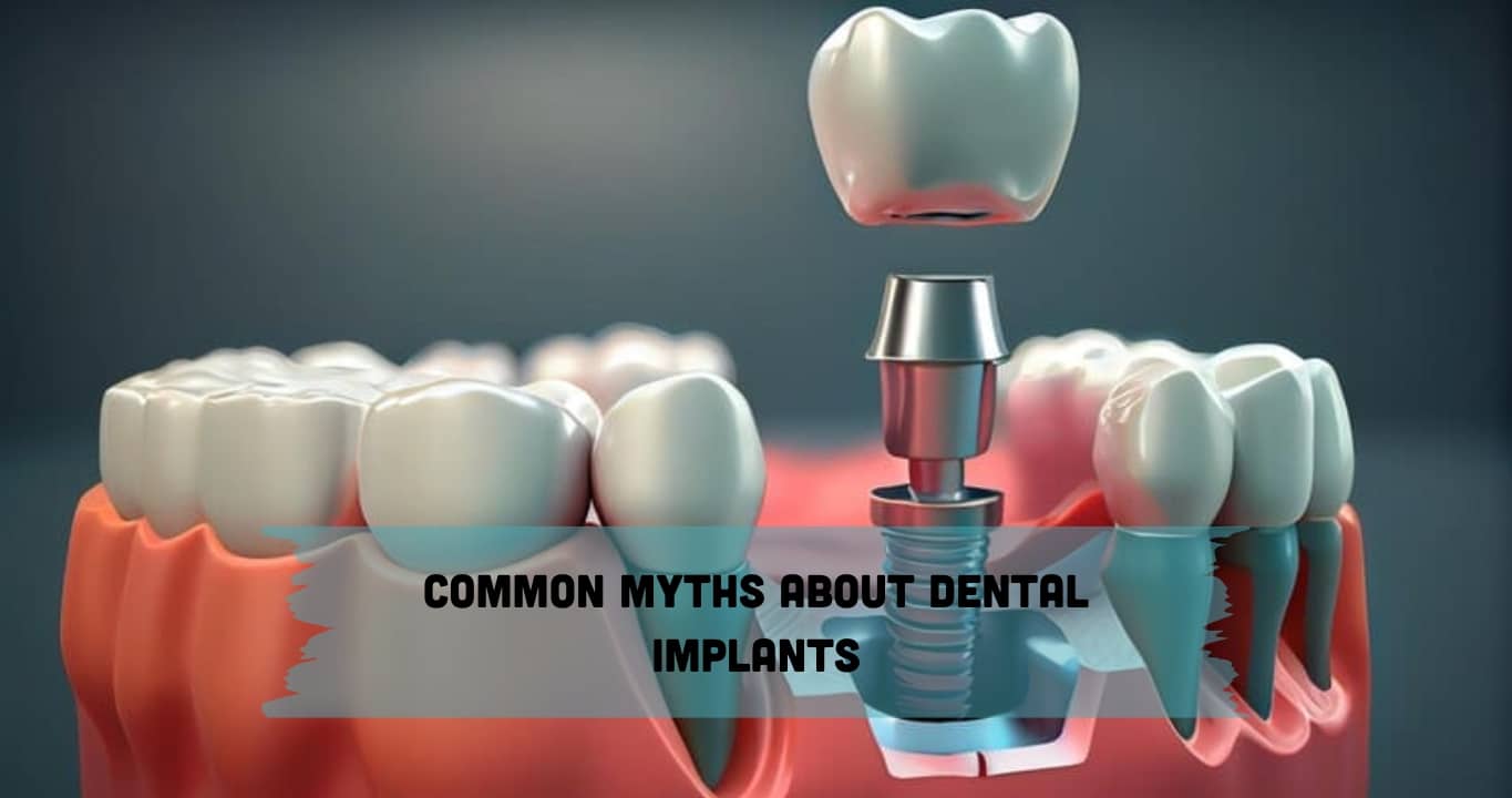 Common Myths About Dental Implants