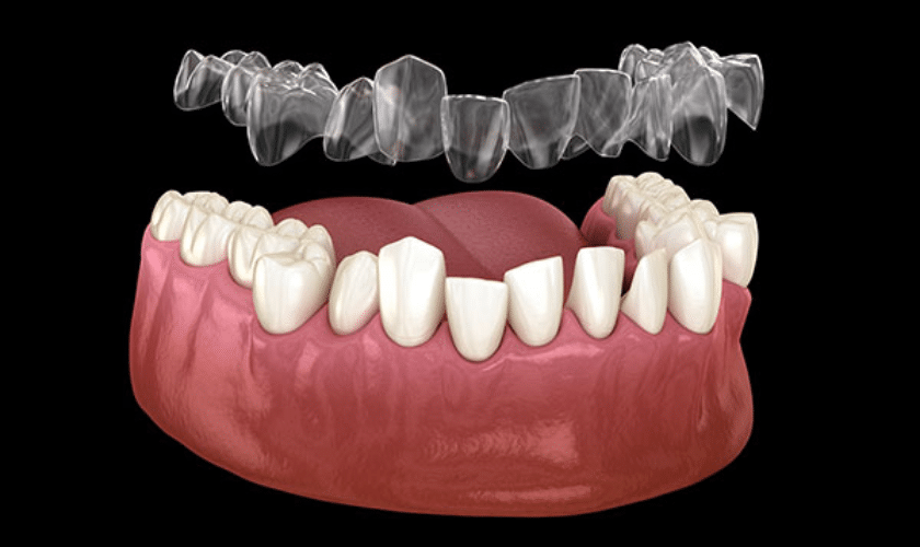 Invisalign Fix Overbite, Underbite, and Crowded Teeth