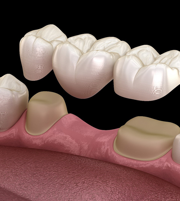 Dental Bridges In Jupiter FL