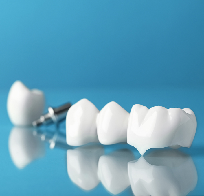 Dental bridges