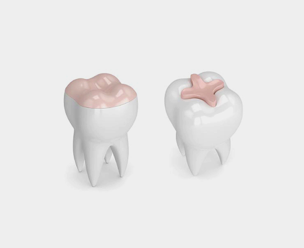 Dental Inlays & Onlays Jupiter FL