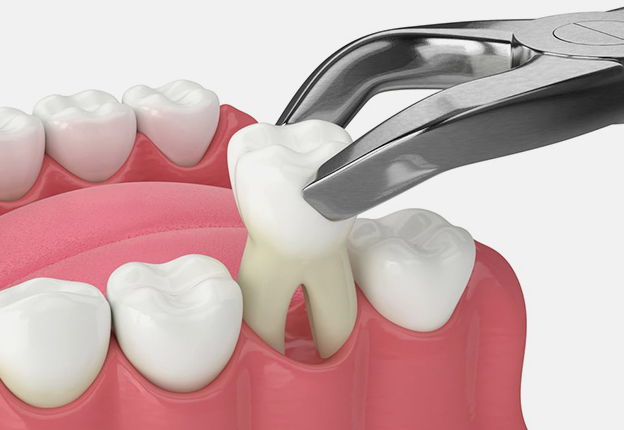 Tooth Extractions In Jupiter FL