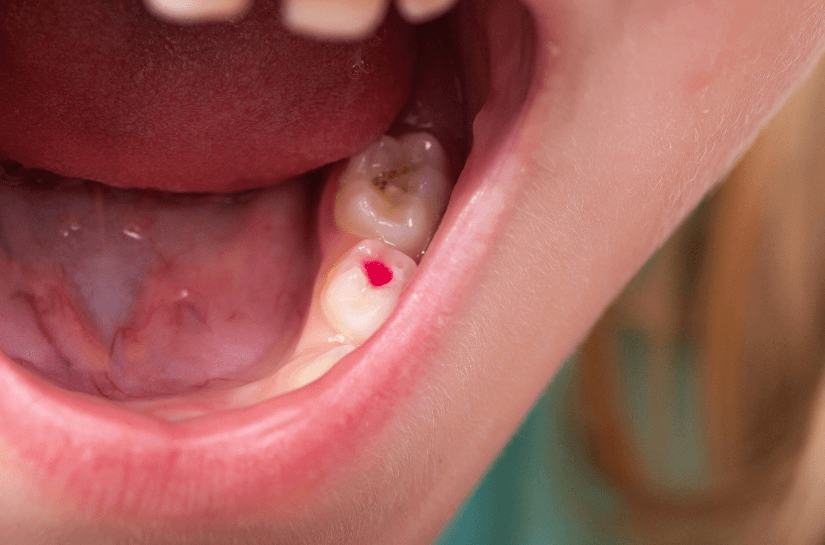 Irreversible Pulpitis Causes And Treatment