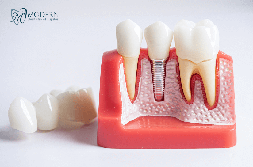 Signs You May Need Dental Implants
