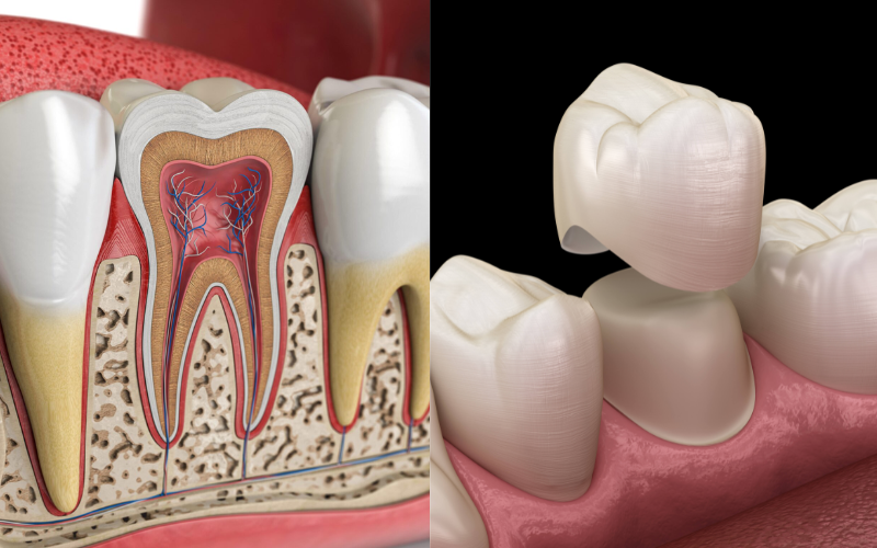 Differences between root canal or dental crown
