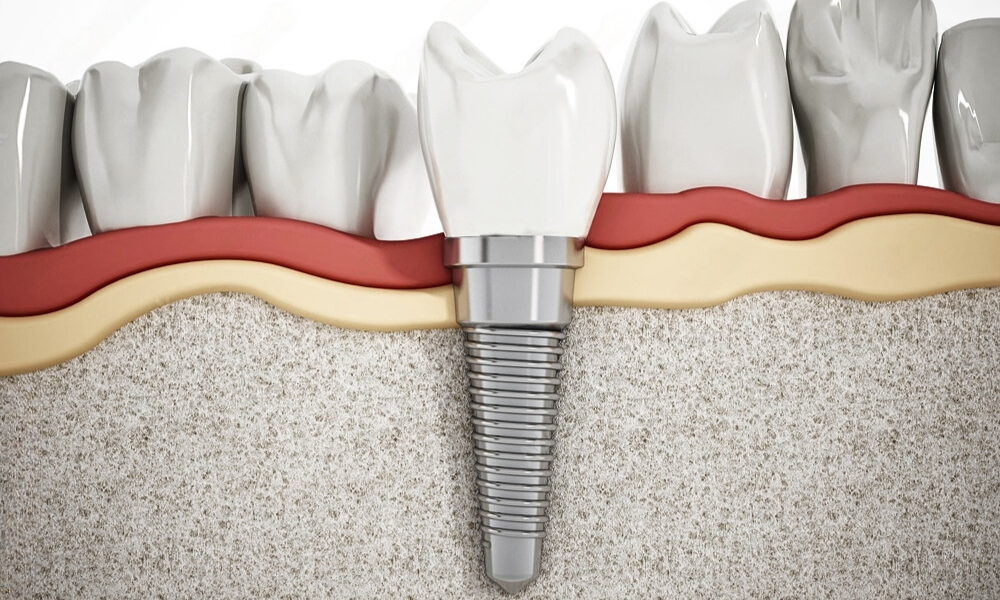 Dental Implant Healing Process