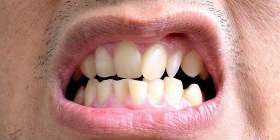 Can Veneers Fix Crooked Teeth