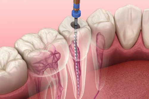 Can a Root Canal Save a Severely Decayed Tooth