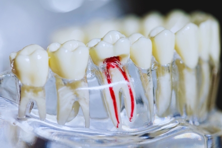 how to spot root canal failure and what to do next