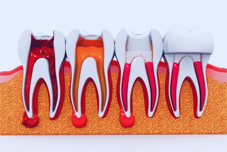 root canal awareness early detection can save your tooth