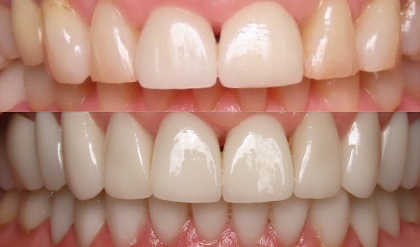 Before & After Smile Makeover Transformations By Dr. Bo Davidson