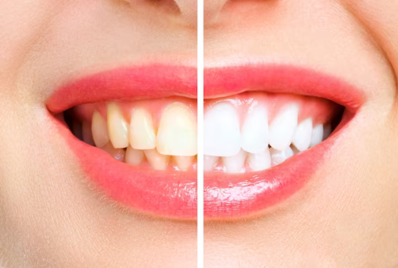 Teeth Whitening in Circleville, OH