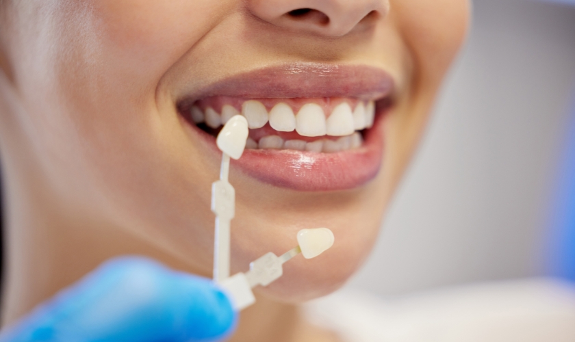 common myths and misconceptions about dental veneers