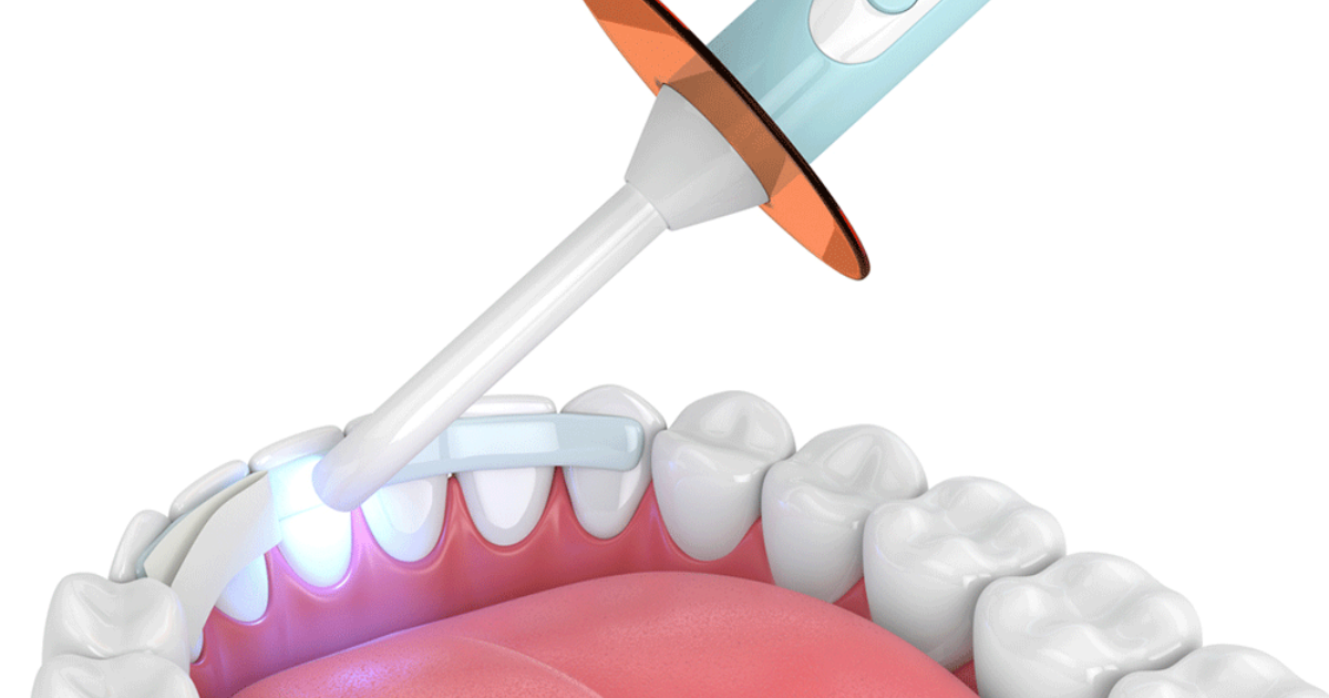 Why Dental Bonding Is the Best Solution for Cracked Teeth Repair