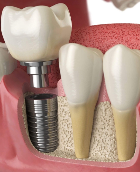 Dental Implants Pasadena, MD - Pasadena Dental Group