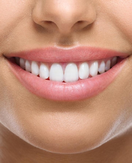 Teeth Whitening Pasadena MD - Pasadena Dental Group