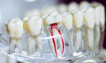 top signs you might need a root canal treatment