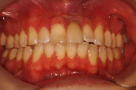 dental implant in Wichita