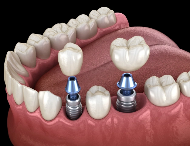 Dental Implants treatment Wichita