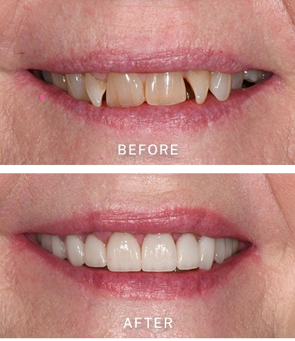 Before and After Dental Bonding Treatment