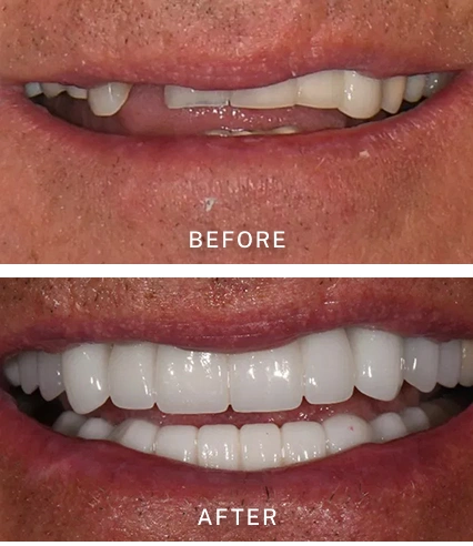 Before and After Implants Treatment at Pauly Dental