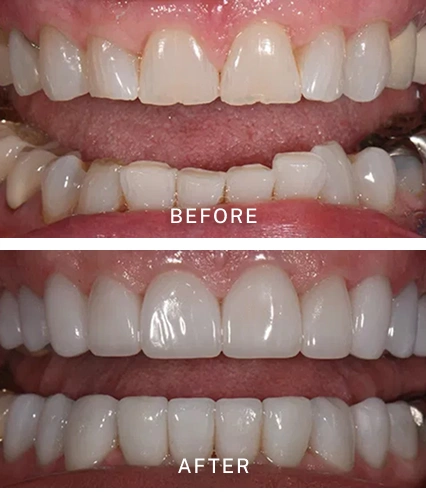 Before and After Smile Makeover at Pauly Dental
