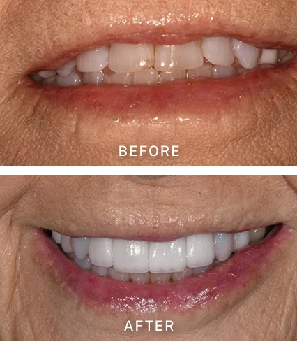 Before and After Veneers Treatment at Pauly Dental