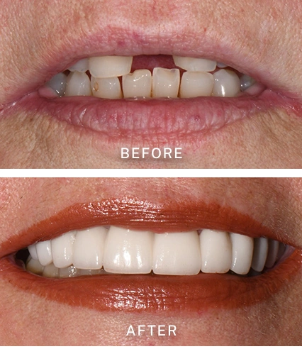 before and after dental work