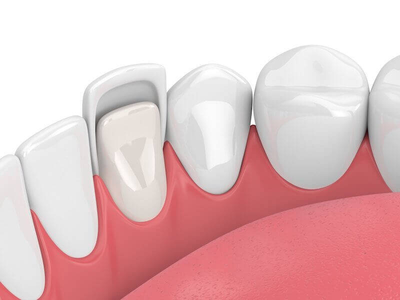 veneers