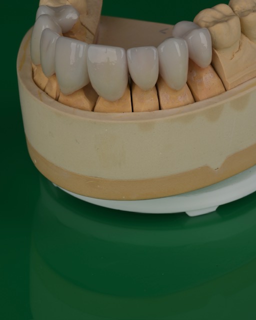 dental veneers