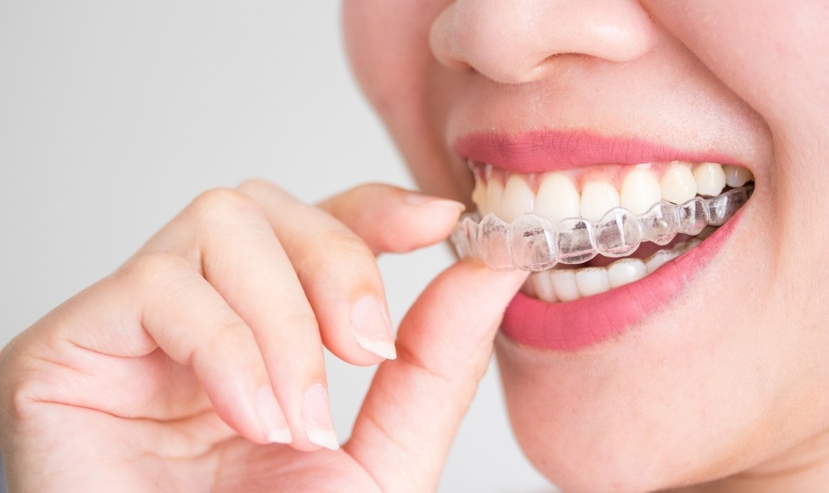 invisalign faqs on compliance and effectiveness
