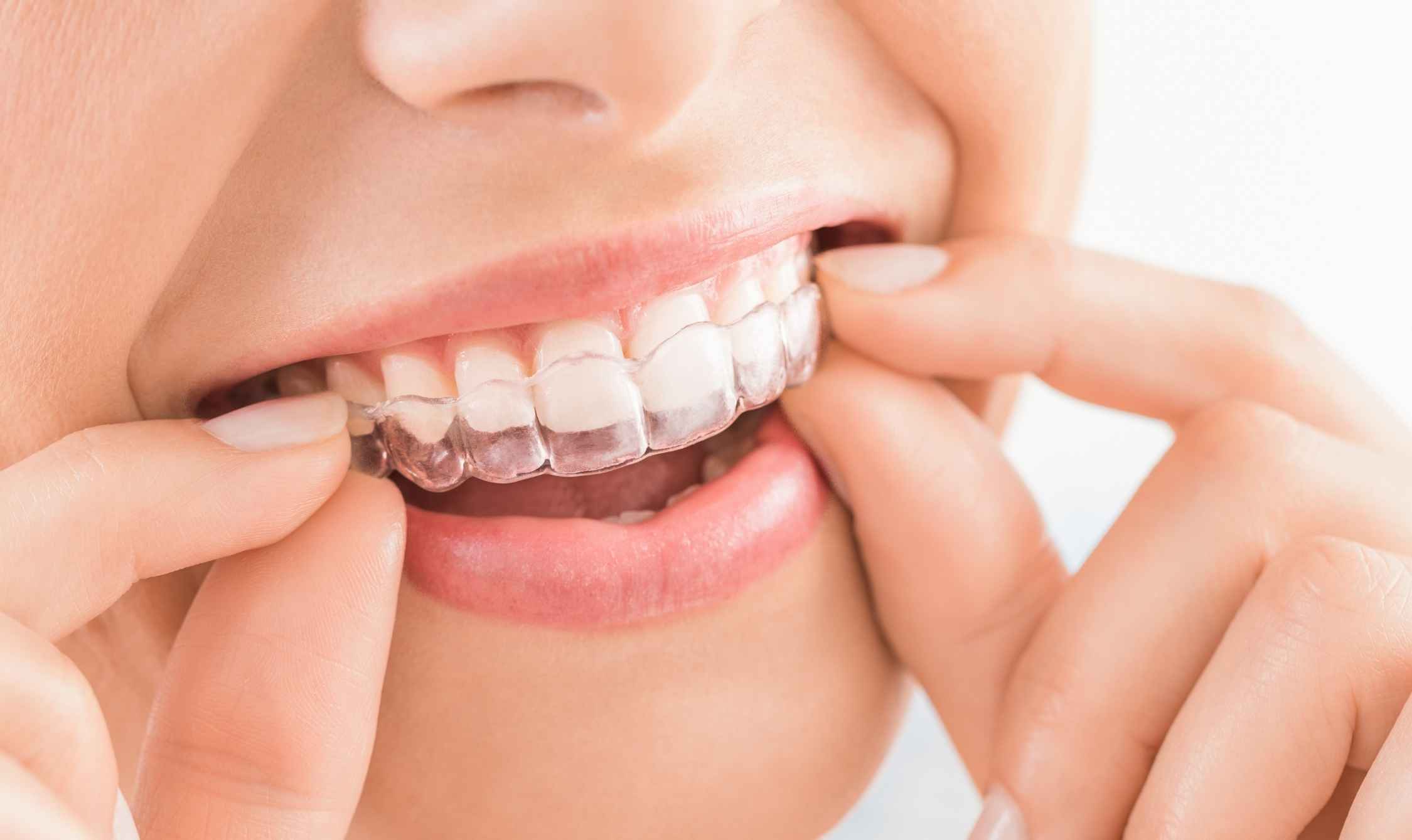 the effectiveness of daily and weekly cleaning of invisalign