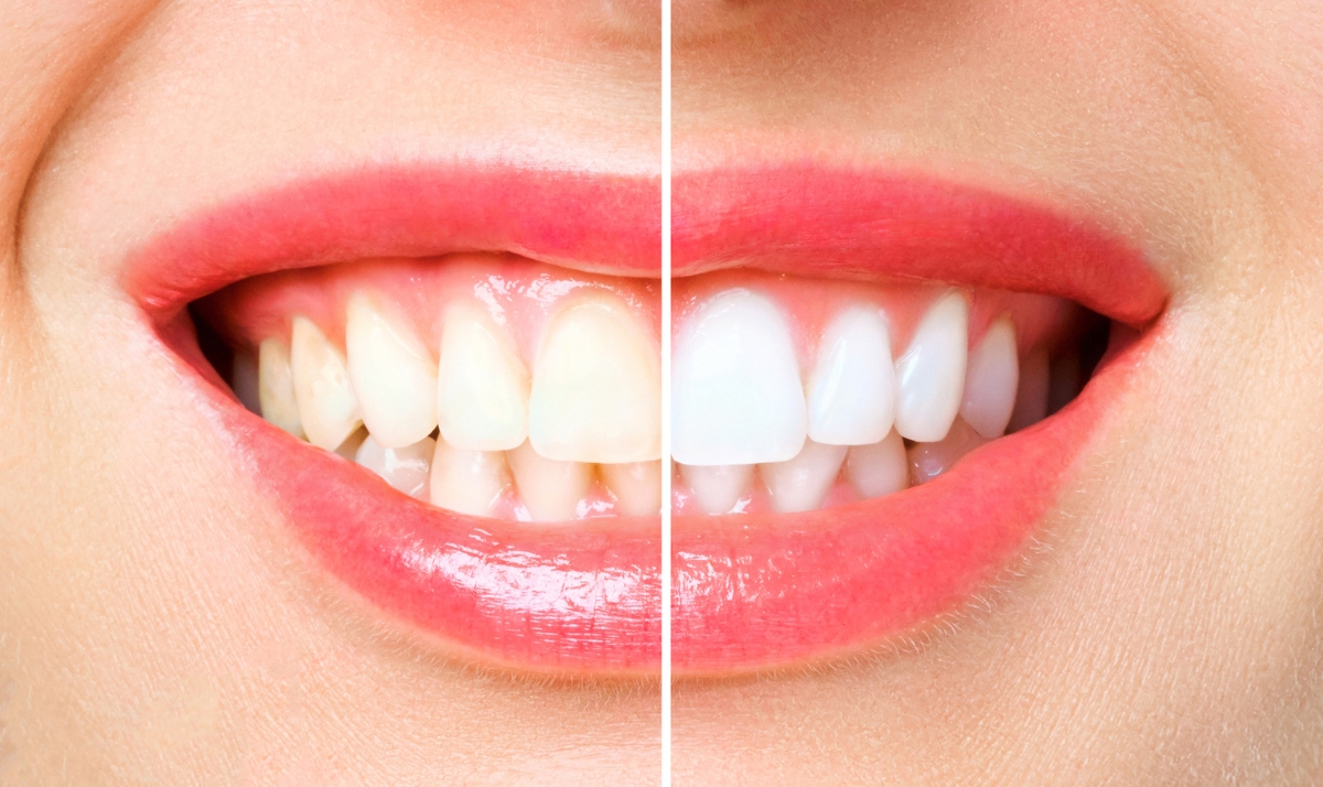 how kor whitening can satisfy patients’ unique whitening needs