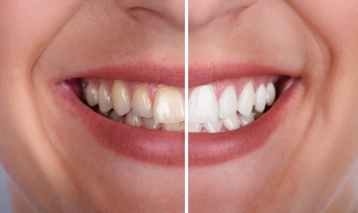 how kor whitening is helping patients with tetracycline stains