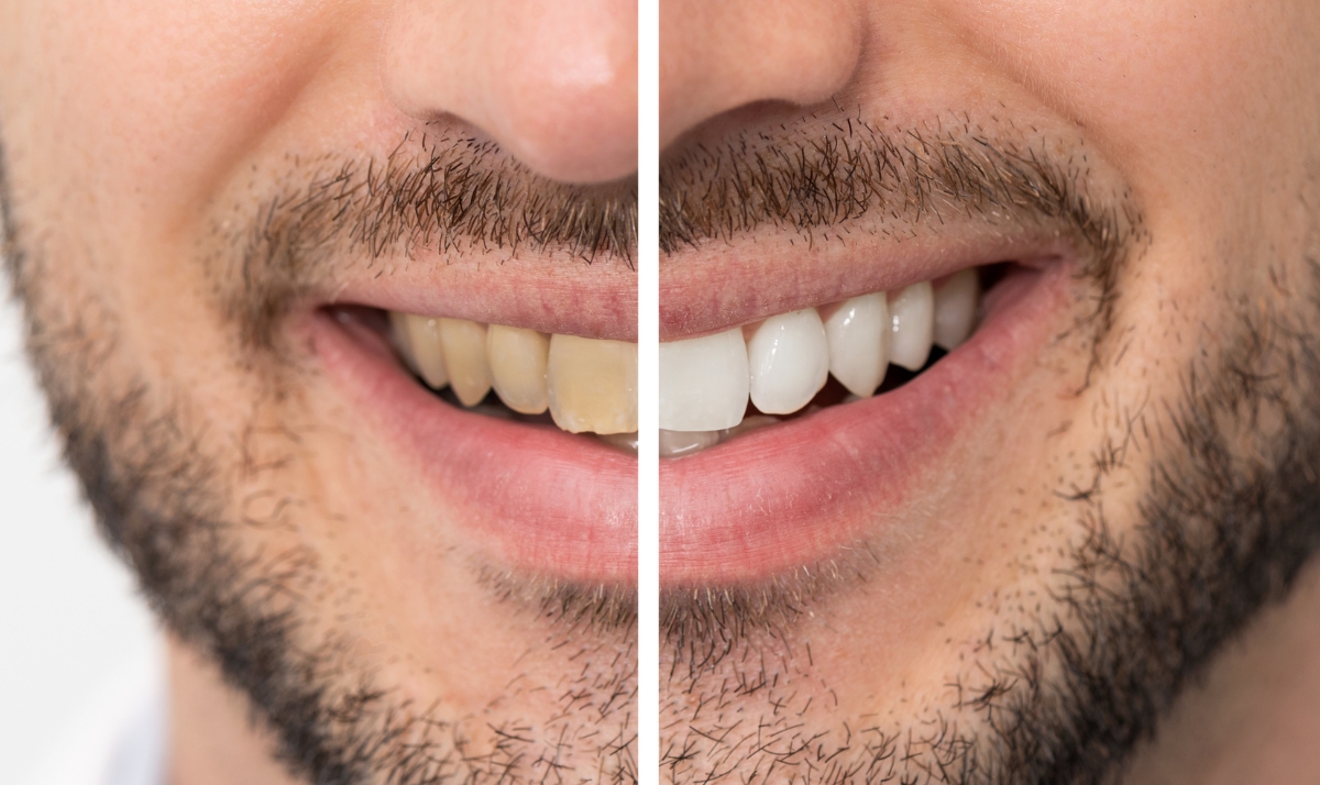 how long kor Whitening takes to show results