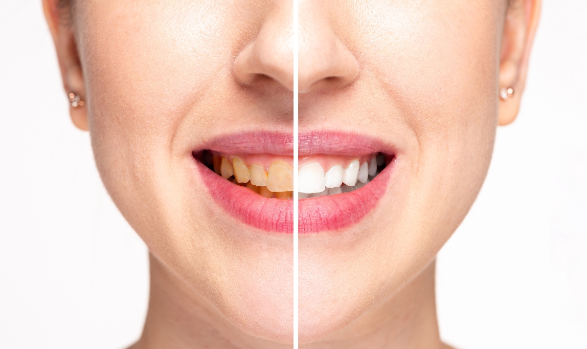 what makes the kor complete treatment your all-around tooth desensitizing product of choice
