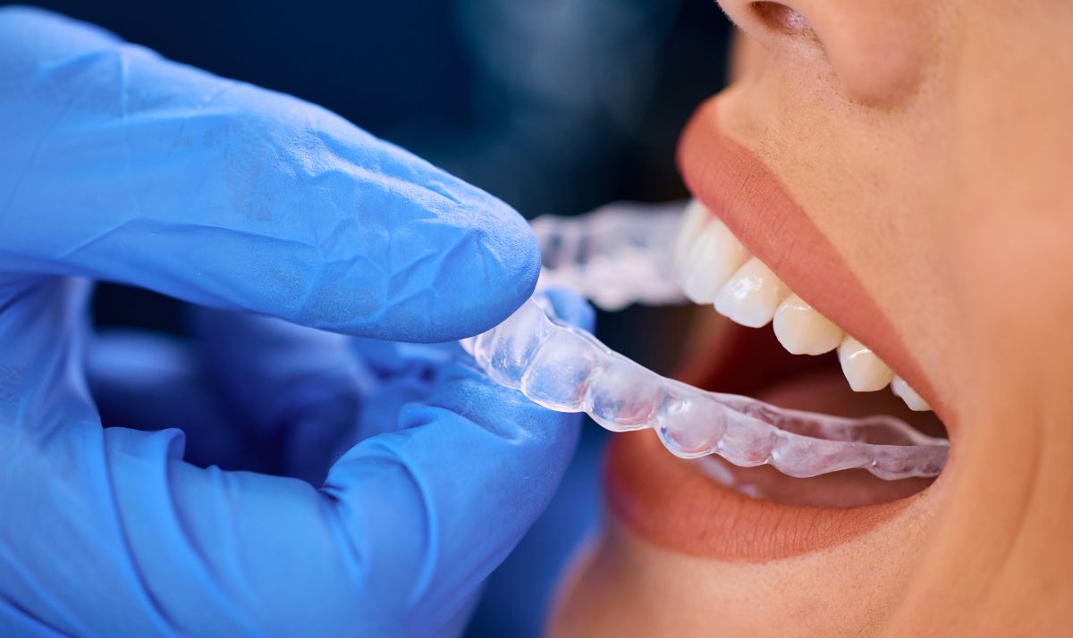 Whiten teeth with Invisalign treatment