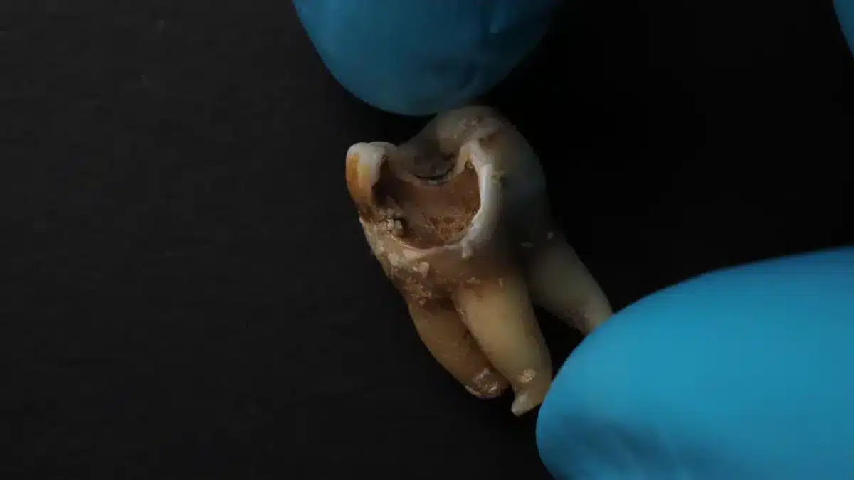 Can A Filling Stop Cavities From Forming In A Tooth?