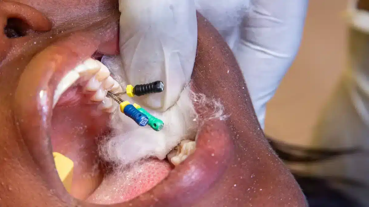 Will a dentist give anesthesia before a root canal treatment?