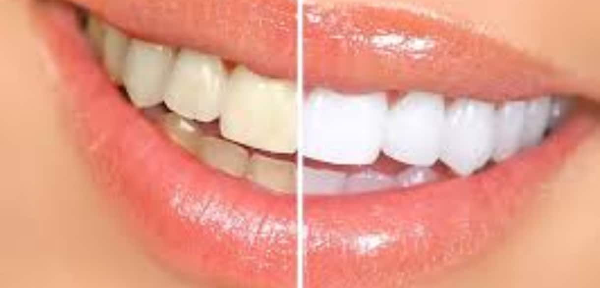 debunking common myths about cosmetic dentistry in butler
