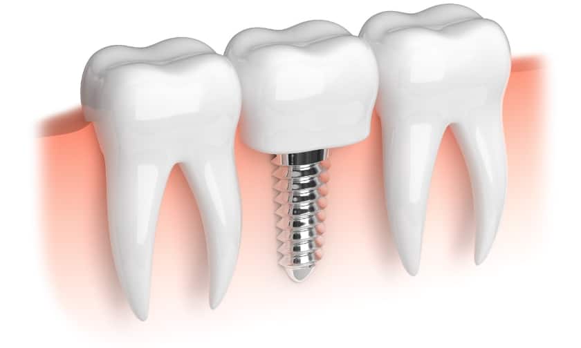 The Success Rate of Dental Implants: Are They Worth It?