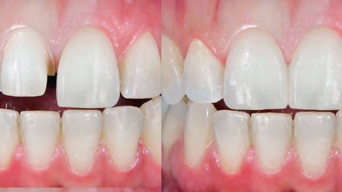 Oral Health with Dental Bonding