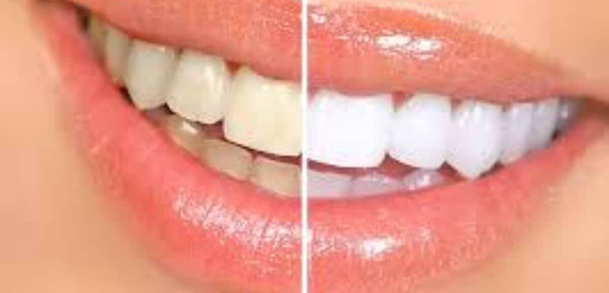 debunking common myths about cosmetic dentistry in butler