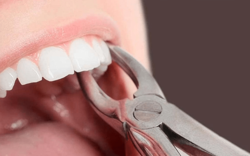 Tooth extraction healing stages