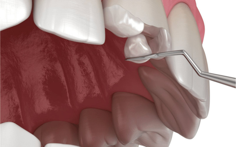 Why dental bonding is affordable
