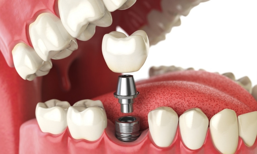 Are Dental Implants Stronger Than Natural Teeth? A Surprising Comparison